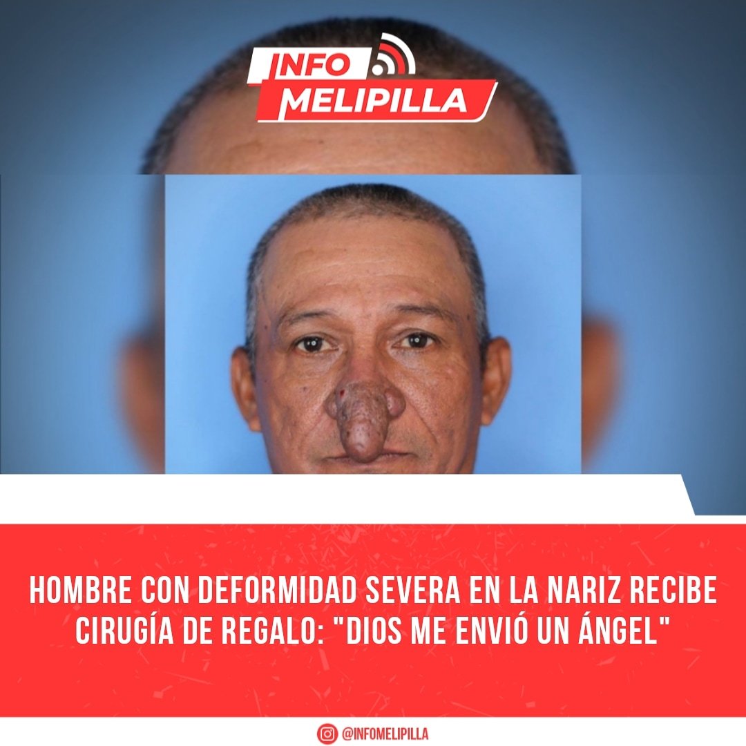 Hombre con deformidad severa en la nariz recibe cirugía de regalo: "Dios me envió un ángel"