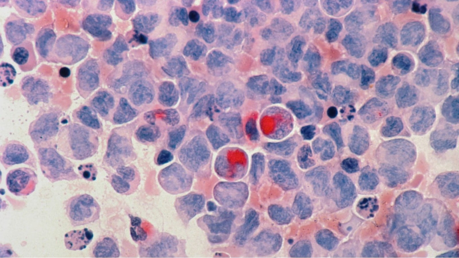 Medicamento contra el cáncer obtiene éxito en primer ensayo con pacientes